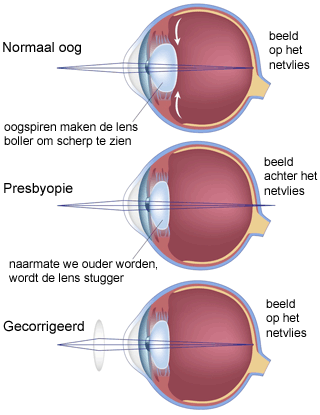 leesbril - presbyopie